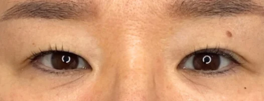 40代女性 埋没法・切らない眼瞼下垂 施術前