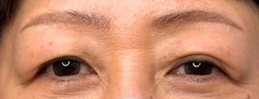 50代女性 埋没法・切らない眼瞼下垂 施術前
