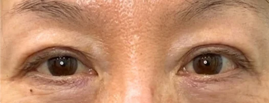 60代女性 埋没法・切らない眼瞼下垂 施術後