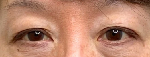 60代女性 埋没法・切らない眼瞼下垂 施術前