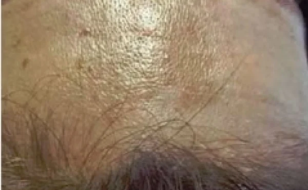 リバースピーリング 施術後