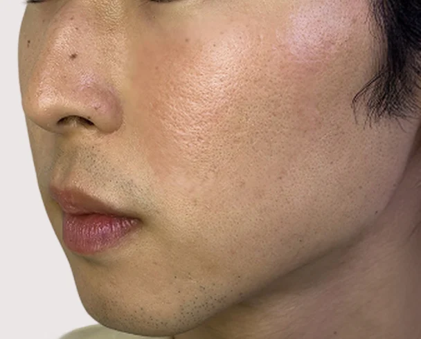 サブシジョン 施術後