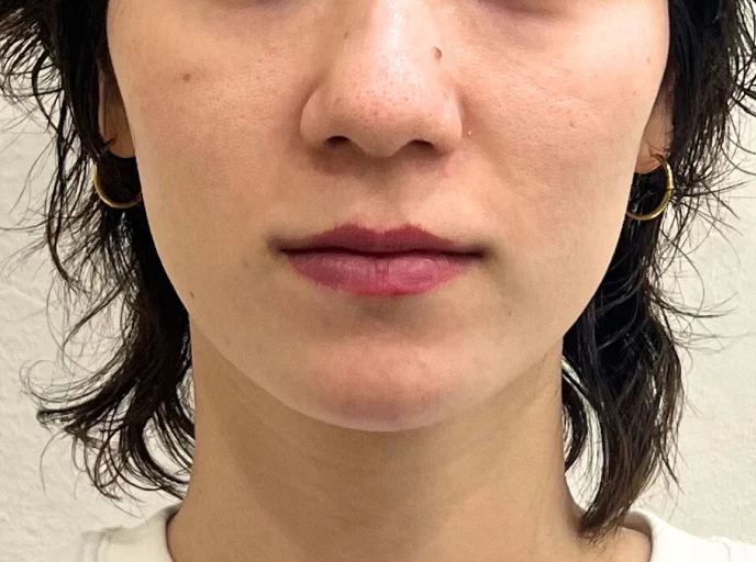 30代女性 糸リフト(スレッドリフト) 施術前