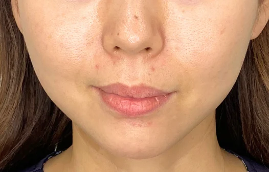 40代女性 ヒアルロン酸注入 施術後