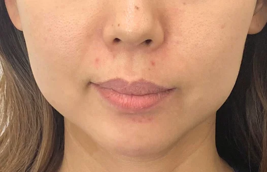 40代女性 ヒアルロン酸注入 施術前