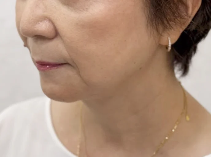 60代女性 糸リフト(スレッドリフト) 施術後