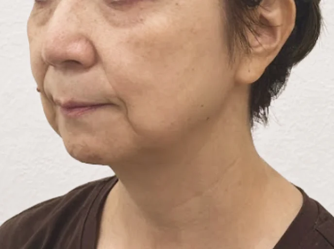 60代女性 糸リフト(スレッドリフト) 施術前