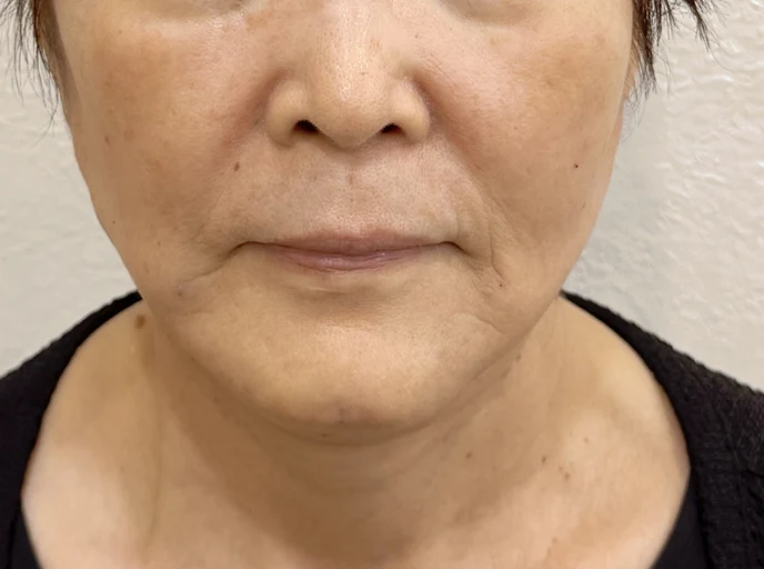 70代女性 糸リフト(スレッドリフト) 施術後