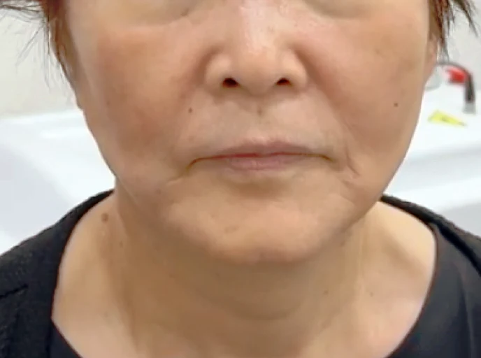 70代女性 糸リフト(スレッドリフト) 施術前