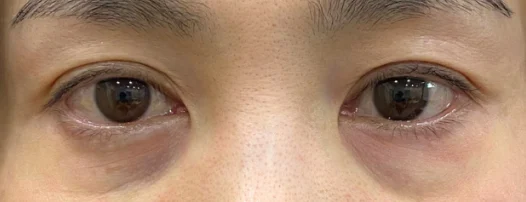 40代女性 目の下の脂肪取り 施術前