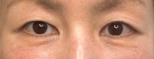 40代女性 目の下の脂肪取り 施術後