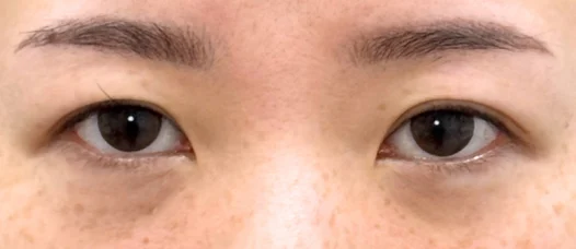 30代女性 目の下の脂肪取り 施術後