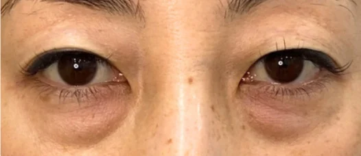 30代女性 ヒアルロン酸注入 施術前