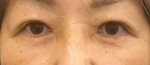 60代女性 目の下の脂肪取り 施術後