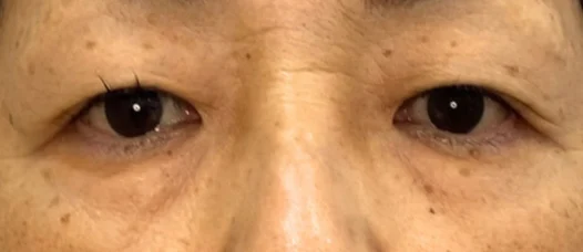 60代女性 目の下の脂肪取り 施術前