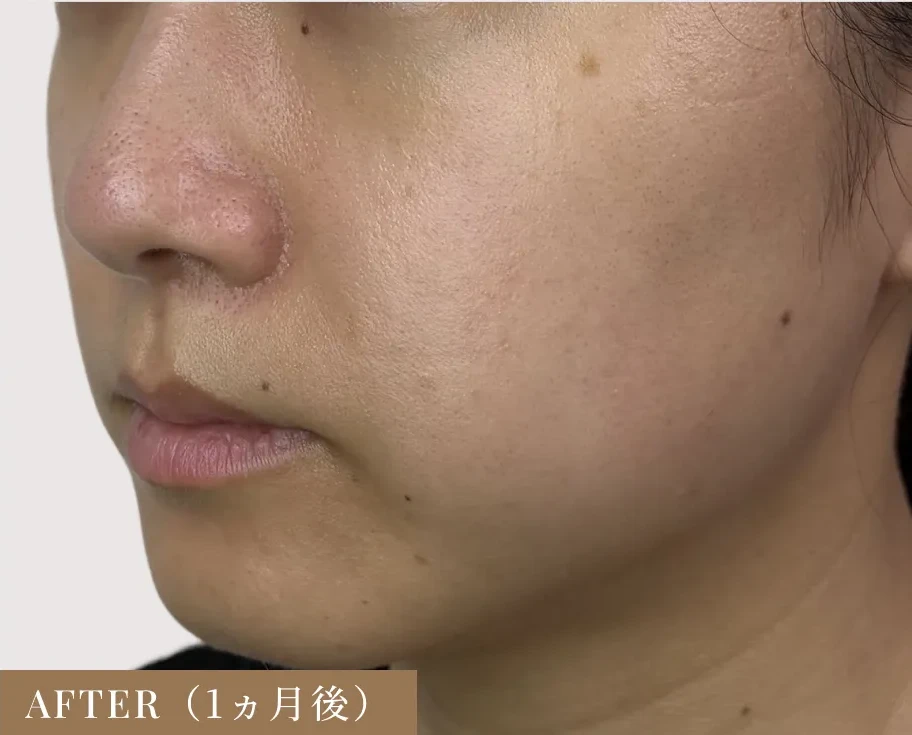20代女性 ボルニューマ 施術後