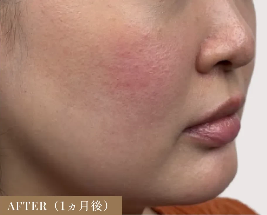 30代女性 ボルニューマ 施術後